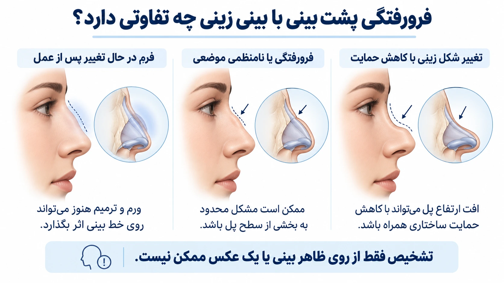 مقایسه فرم در حال ترمیم، فرورفتگی موضعی و بینی زینی همراه با کاهش حمایت