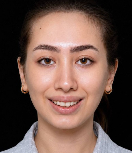 قبل — نتیجه جراحی زیبایی بینی — نمونه ۵