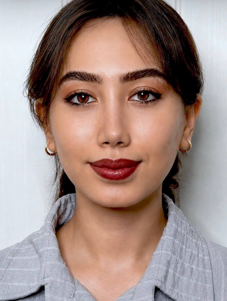 بعد — نتیجه جراحی زیبایی بینی — نمونه ۵