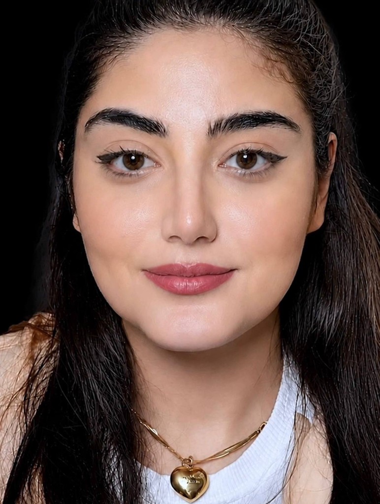 بعد — نتیجه جراحی زیبایی بینی — نمونه ۶