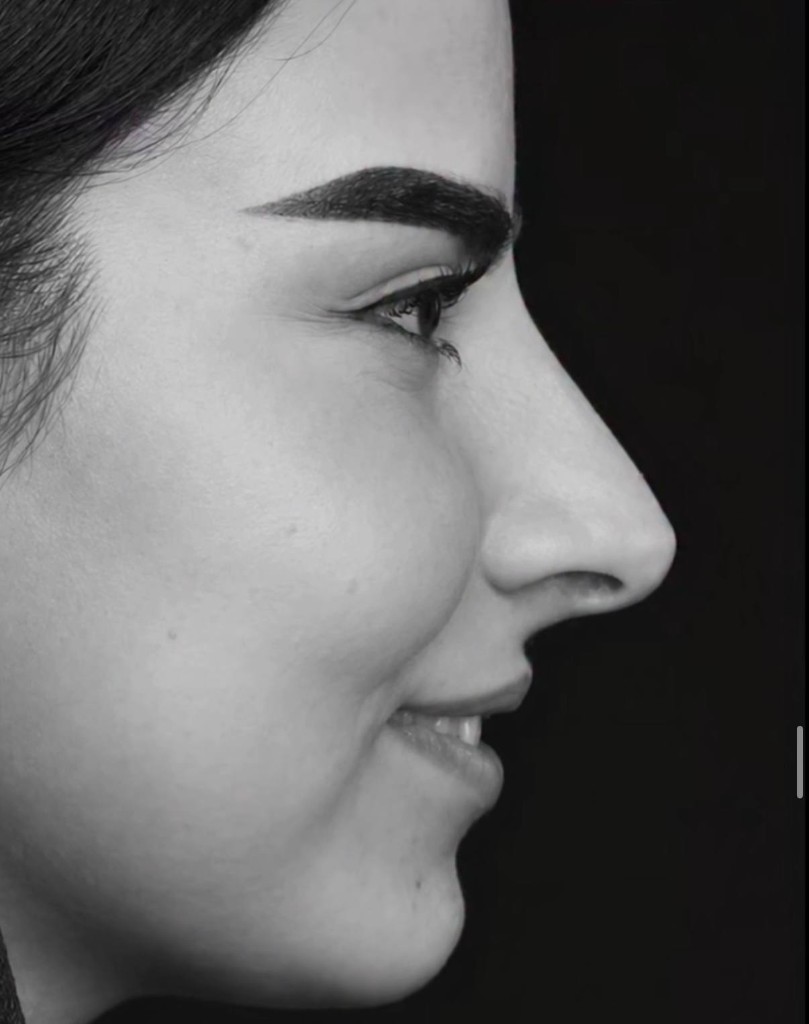 قبل — نتیجه جراحی زیبایی بینی — نمونه ۹ نمای نیم‌رخ